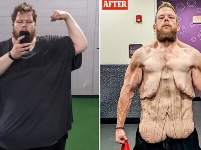 تصاویر شوکه کننده مردی که ۱۵۲ کیلو وزن کم کرد!